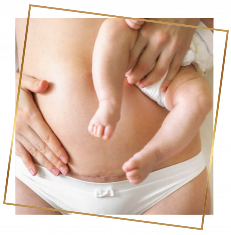 Zdrowie Twojej Blizny Po Porodzie - cesarskie cięcie